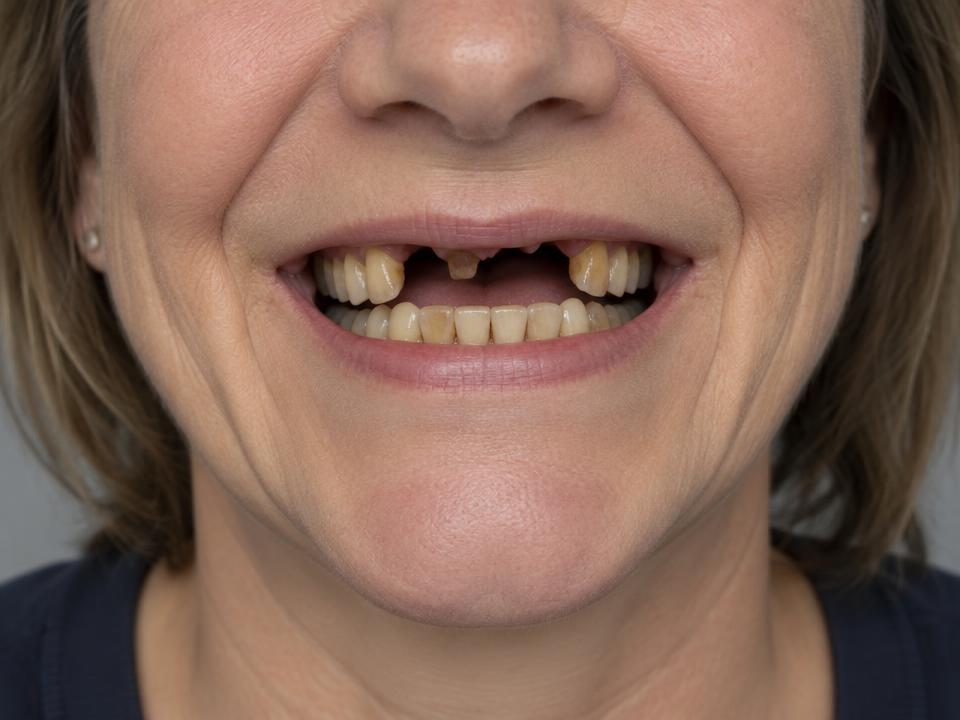 Illustrative smile before implant treatment — Gaps gone, confidence back